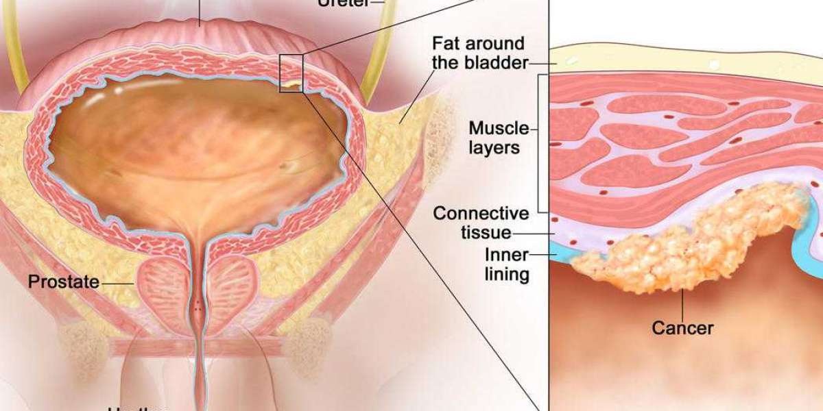 Laser Therapy For Bladder Cancer